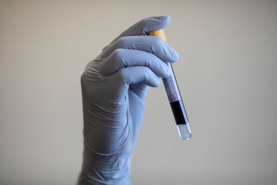 Cancer-detecting blood test ‘feasible at scale’ on NHS #CancerAwareness #BloodTest #NHS #EarlyDetection #HealthInnovation
