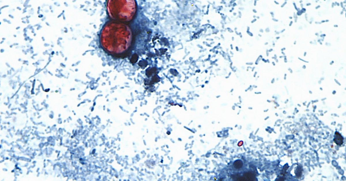 Cyclospora outbreak tied to 3 more states, FDA says 1 18b9551a2bc5b2f0723dfbef022717aefea7dc7550070356f7d2498dfea53602