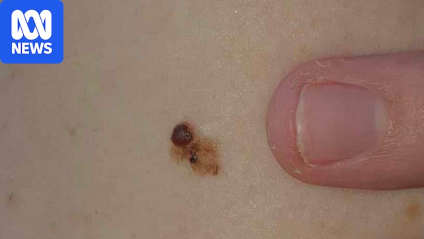 New 'landmark' drug shown to prevent recurrence of deadly melanoma 1 21a80c042afb40cb27dc95456e228658a655e19796d0010e56e73c4ed059dabe