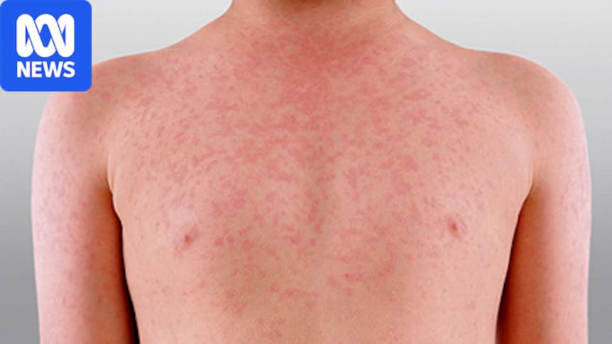 Study warns of measles risk with 1.7 million Australians vulnerable 1 d47ba03abb9e379df2a13cbc36e578f0b255783bac8e70a8e83842e3fd85003b