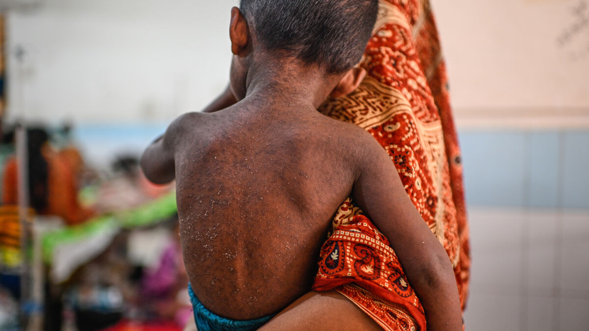 Bangladesh measles outbreak kills more than 1,000 children 1 11a31f413834540b29446c9a751af7b62b572dc3cbb4faa13c22b0e576d2bbf1