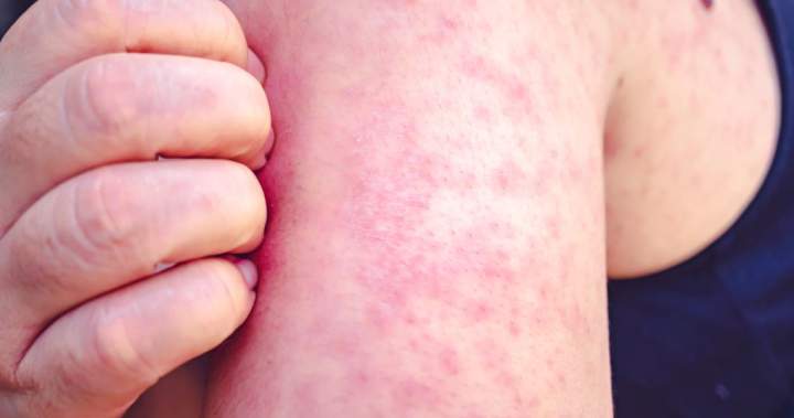 Canada’s 2-year measles outbreak officially over: PHAC 1 324375be7fd8dd2e04d666a3d9855902b025f7a94cbe44ad72eef0799eaa1c72